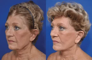 face and neck lift