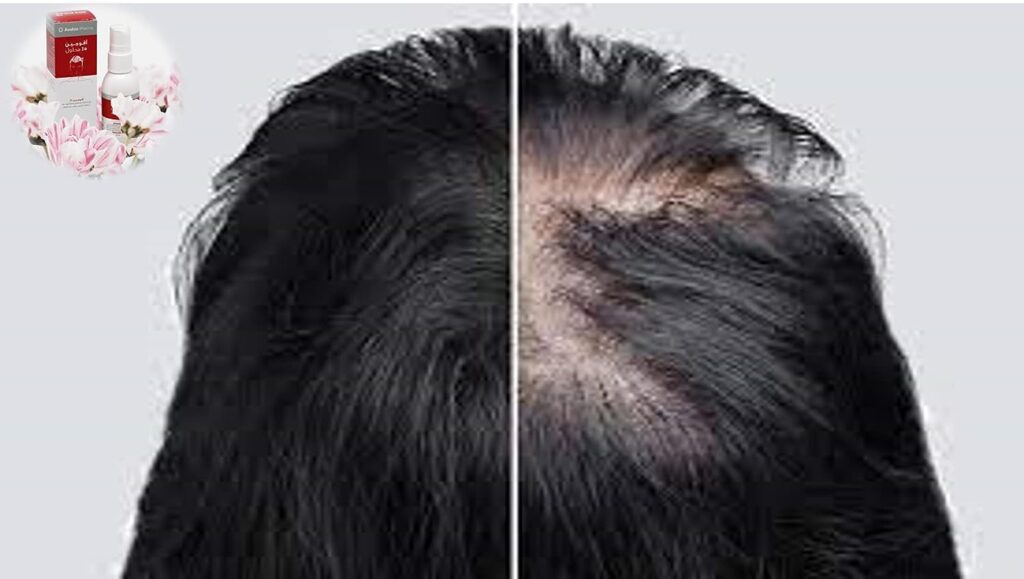أفوجين بخاخ 5% مينوكسيديل, محلول موضعي يمنع تساقط الشعر ويعيد نموه Avogain 5% Minoxidil solution Prevents hair loss and Improve regrowth 50ml