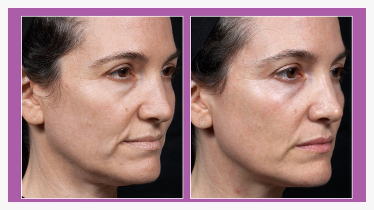 Benefits Of Radiofrequency Tools For Skin Tightening