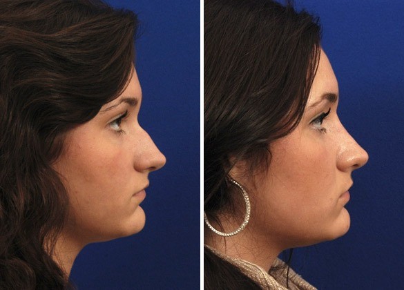 Bespoke Rhinoplasty Solutions For Every Unique Face