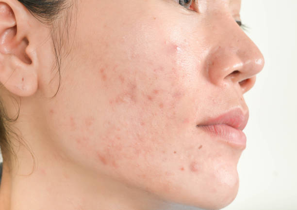 From Acne To Zits: Stylish.aes Guide To Navigating Oily Skin Challenges