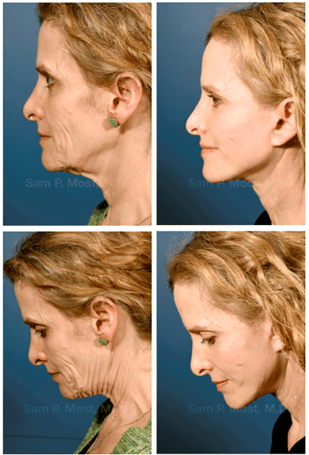 Lifting The Veil: Myths And Facts About Face Neck Lifts
