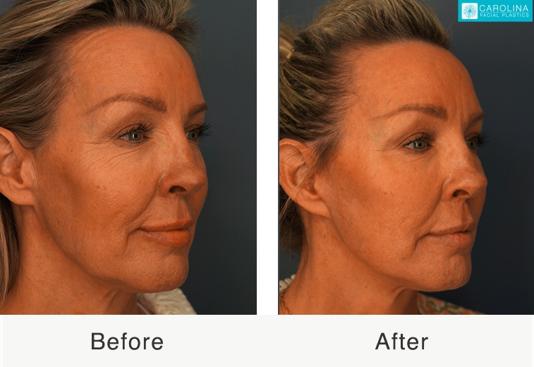 Lifting The Veil: Myths And Facts About Face Neck Lifts