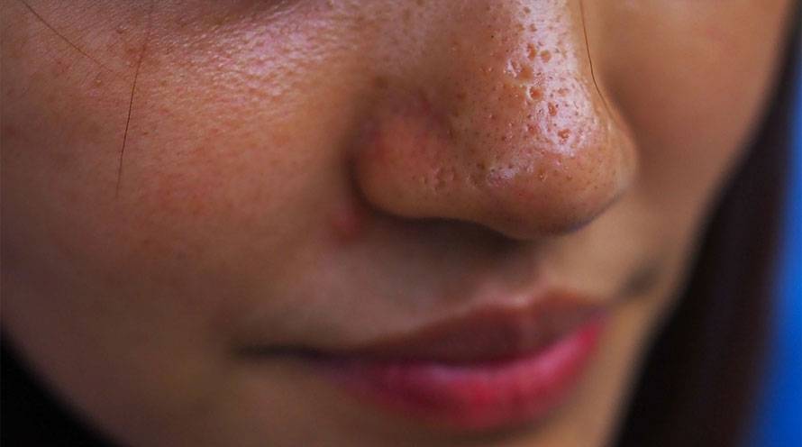 Oily Skin Origins: Breaking Down The Causes With Stylish.ae