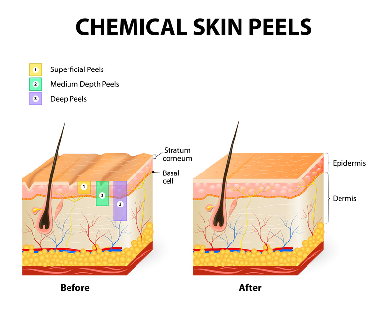 Peels Your Skin: Finding The Right Intensity And Type