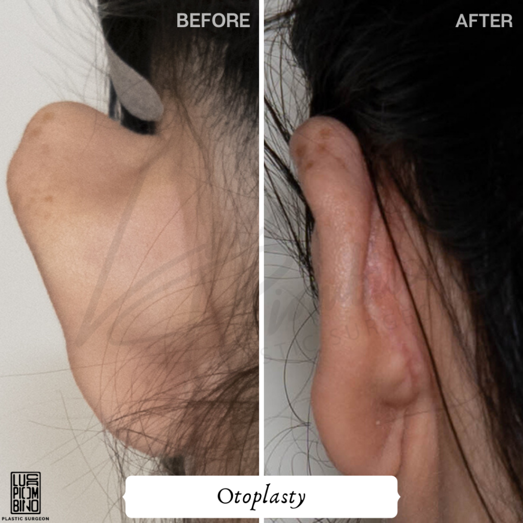 Stylish.ae Spotlight: Crafting The Perfect Ear Through Otoplasty