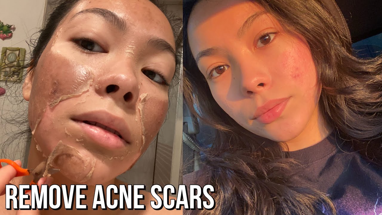 Stylish.aes Deep Dive: The Truth About Chemical Peels