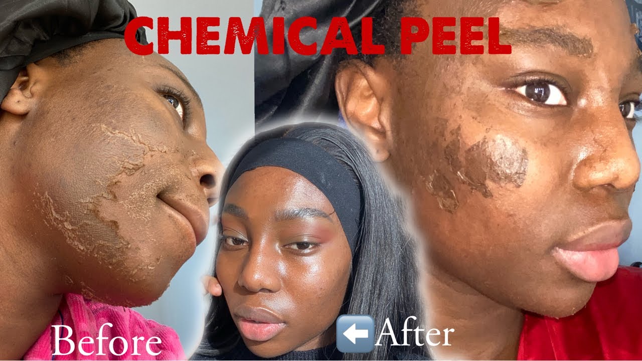 Stylish.aes Deep Dive: The Truth About Chemical Peels