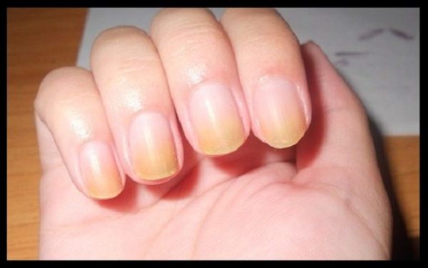 Yellowing of Nails