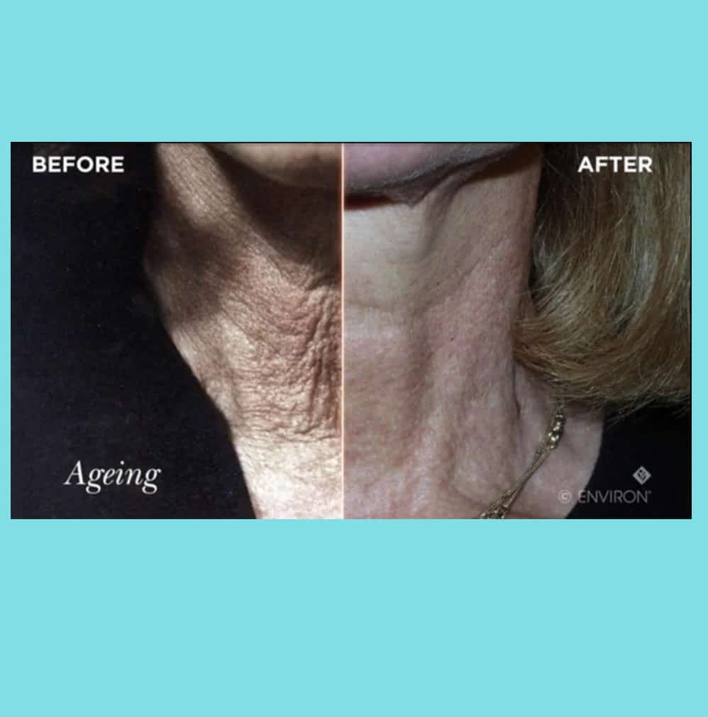 Aging Gracefully: How Face Neck Lifts Revitalize Your Radiance