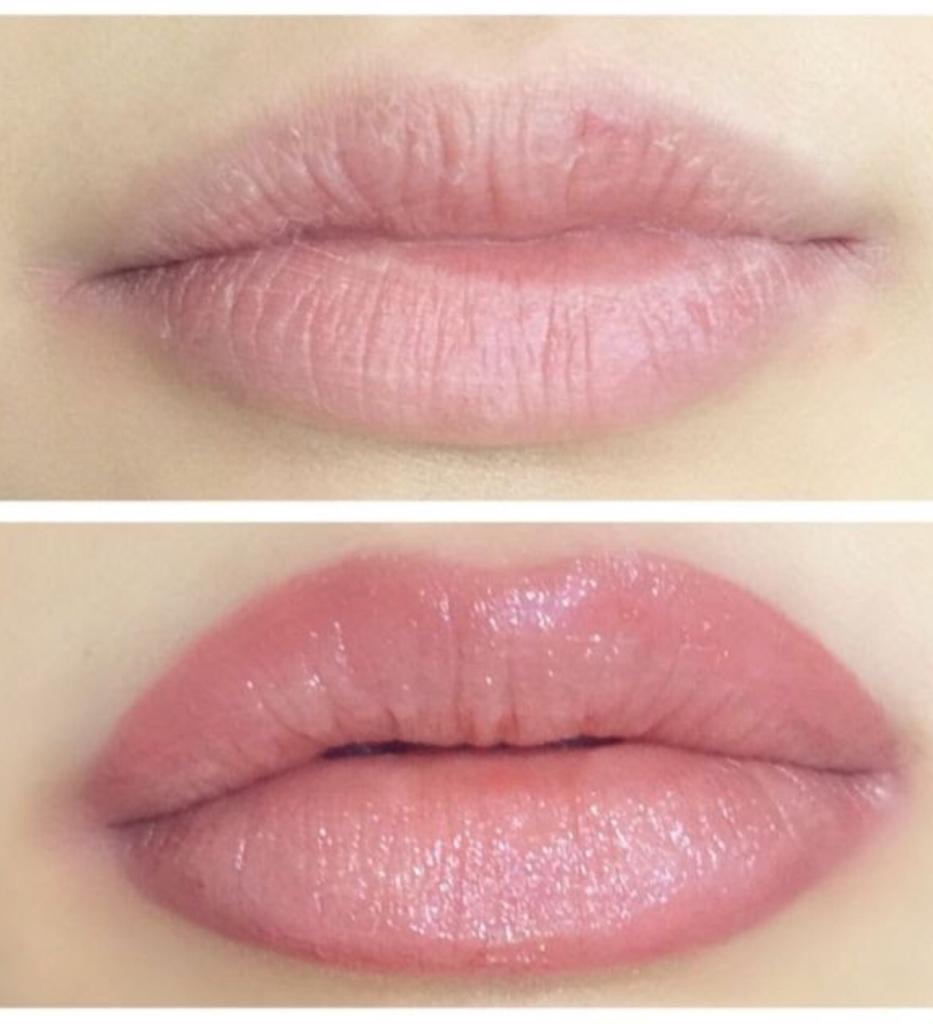 Correcting Asymmetrical Lips