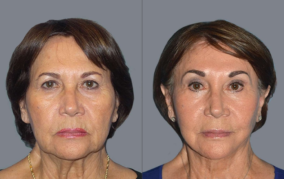 Discovering The Best Age For A Facelift: Expert Advice From Stylish.ae