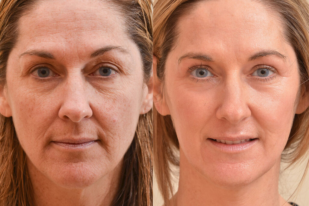 Personalized Glow: Laser Resurfacing Just For You On Stylish.ae