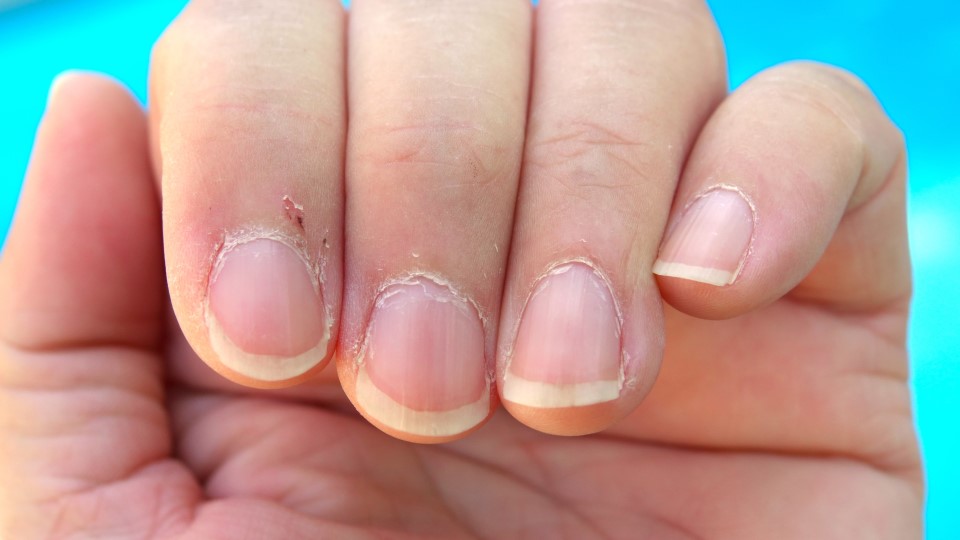 Quick Fixes: Addressing Common Nail Problems Like A Pro