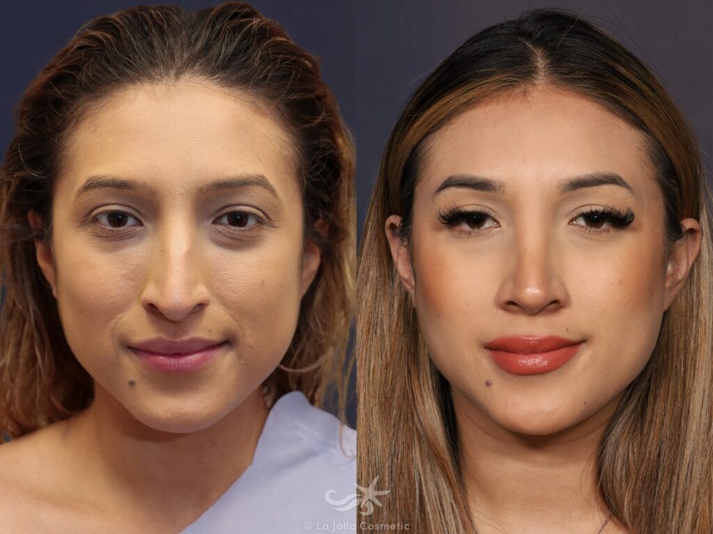 Rhinoplasty: A Deep Dive Into Tailoring Your Ideal Nose