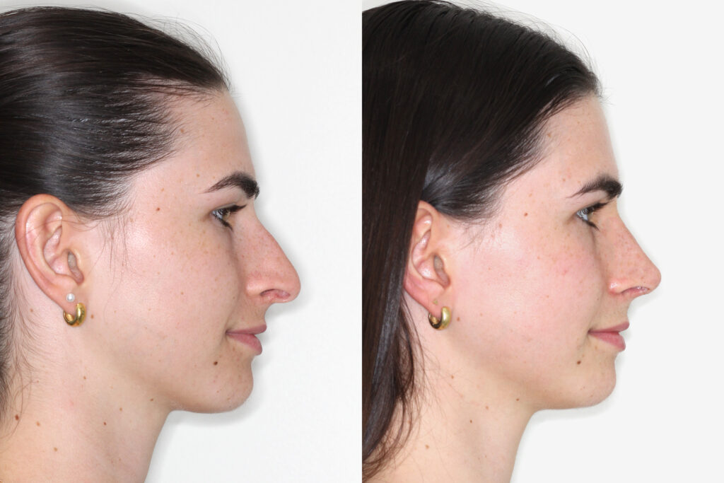 Rhinoplasty: A Deep Dive Into Tailoring Your Ideal Nose