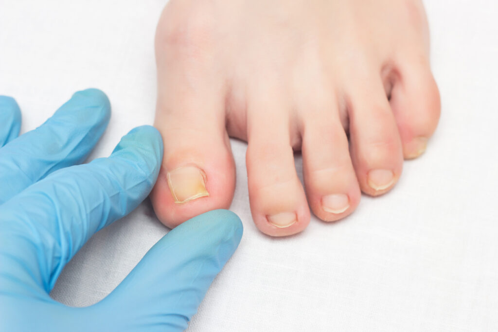 Tackling Toenail Troubles: Solutions For Common Pedicure Problems