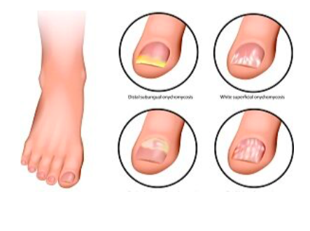 Tackling Toenail Troubles: Solutions For Common Pedicure Problems