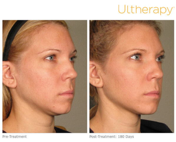 Ultherapy: Your Answer To Graceful Aging
