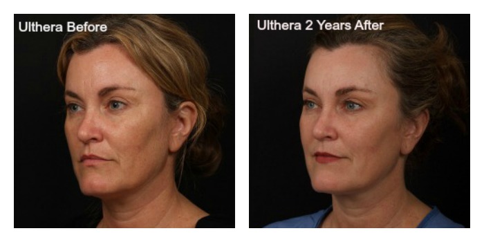 Ultherapy: Your Answer To Graceful Aging