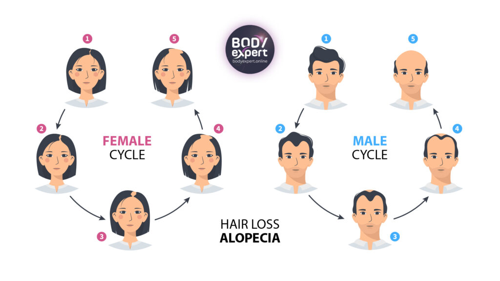 Understanding Hair Loss Patterns And Solutions With Stylish.ae