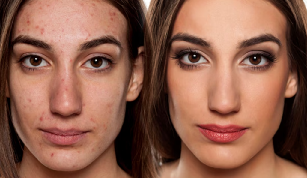 Acne Makeup