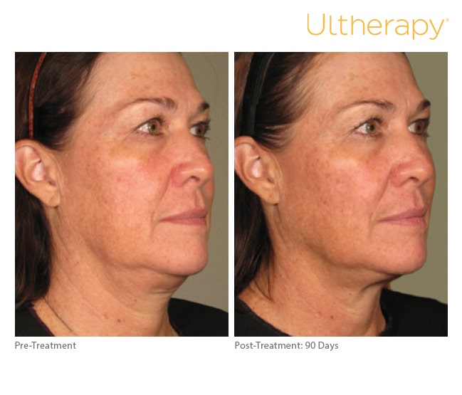 Define, Lift, Celebrate: Your Ultherapy Journey