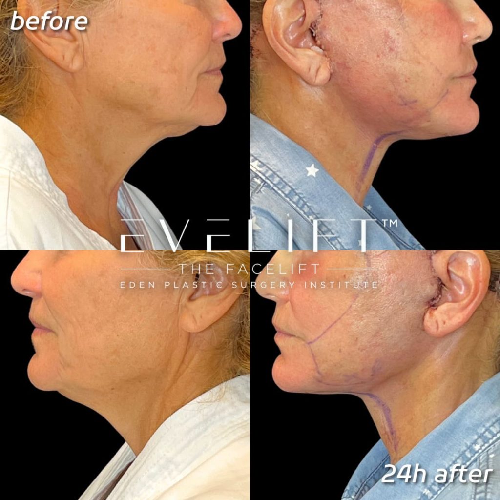Personalized Non-Surgical Facelifts: The Art Of Subtle Elevation