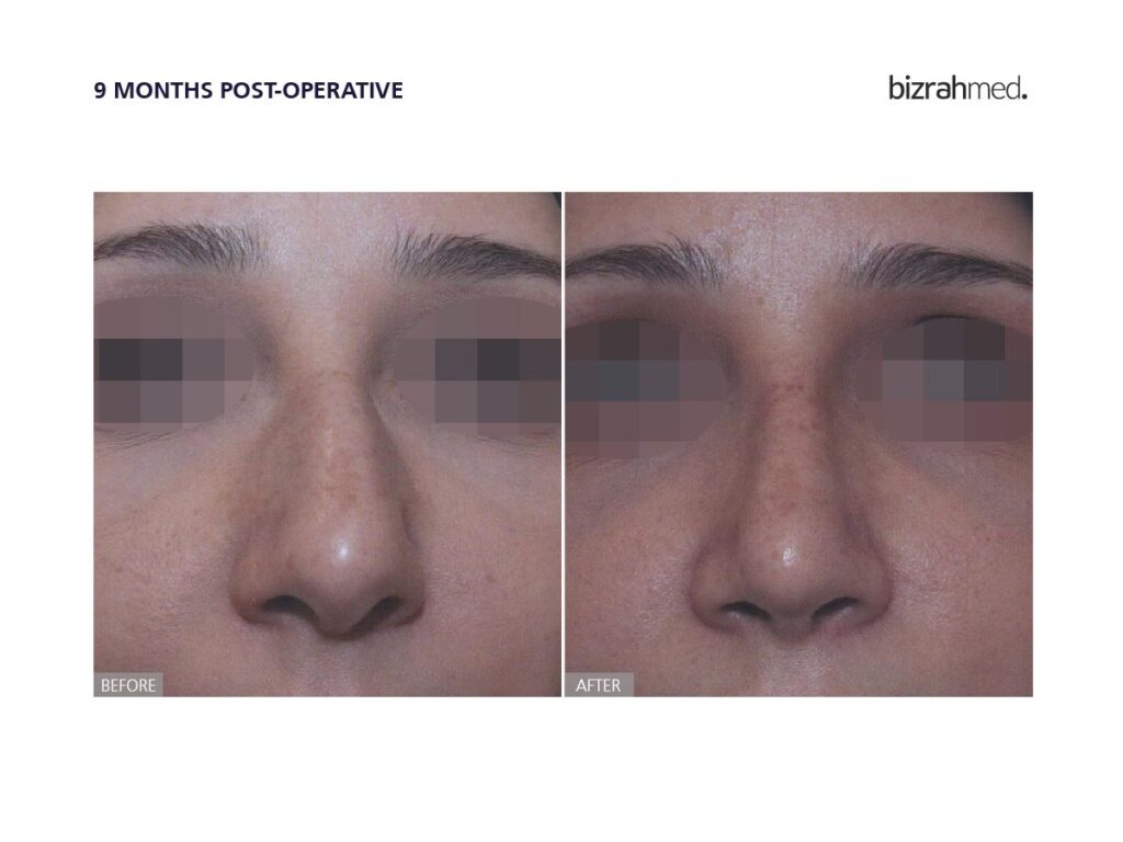 The Future Of Rhinoplasty: Innovations And Trends In Dubai